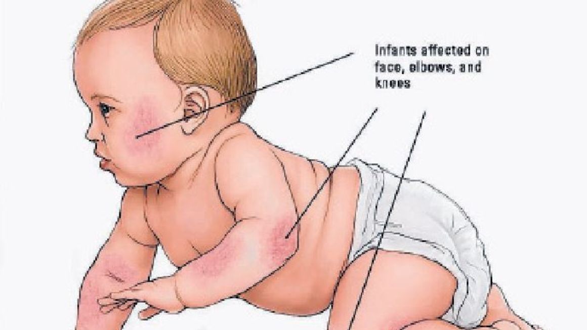 Baby eczema tips on what to expect and how to control it The Citizen