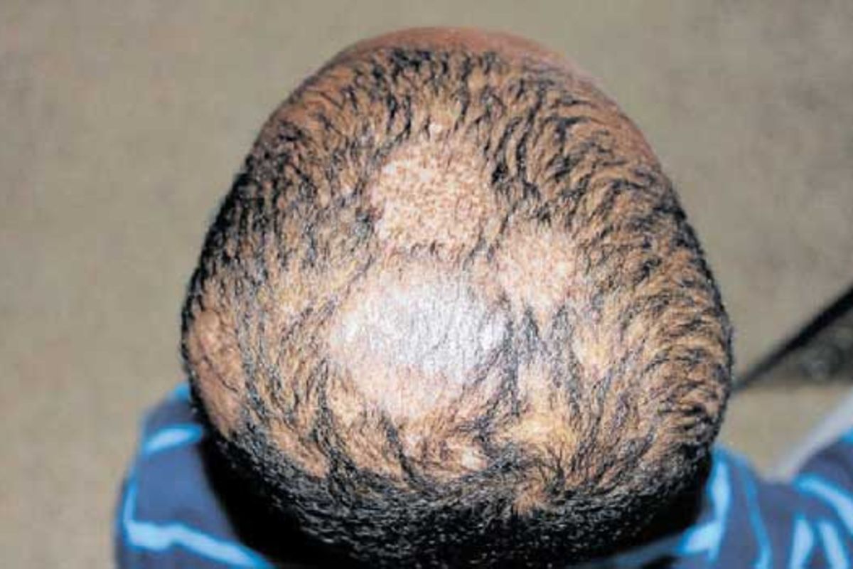 When ringworm of the scalp causes hair loss in your child | The Citizen