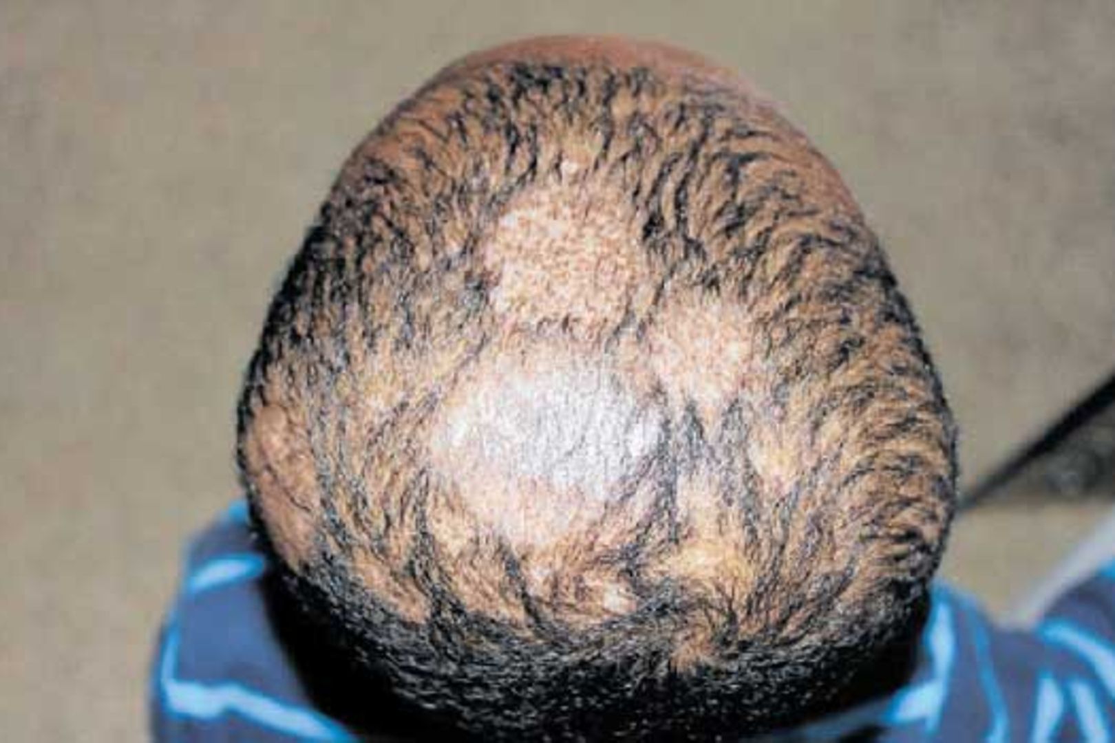 When ringworm of the scalp causes hair loss in your child | The Citizen When ringworm of the scalp causes hair loss in your child | The Citizen