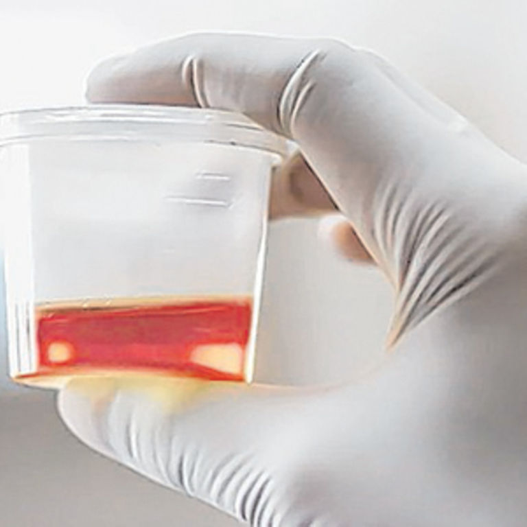 Blood in the urine Possible causes of this strange sign The Citizen