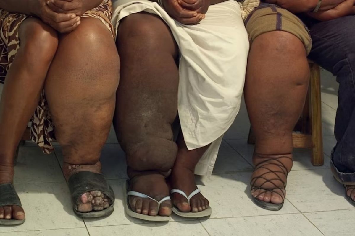 How treating elephantiasis cuts HIV risk in Tanzania