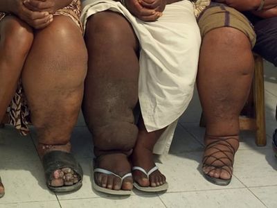 How treating elephantiasis cuts HIV risk in Tanzania